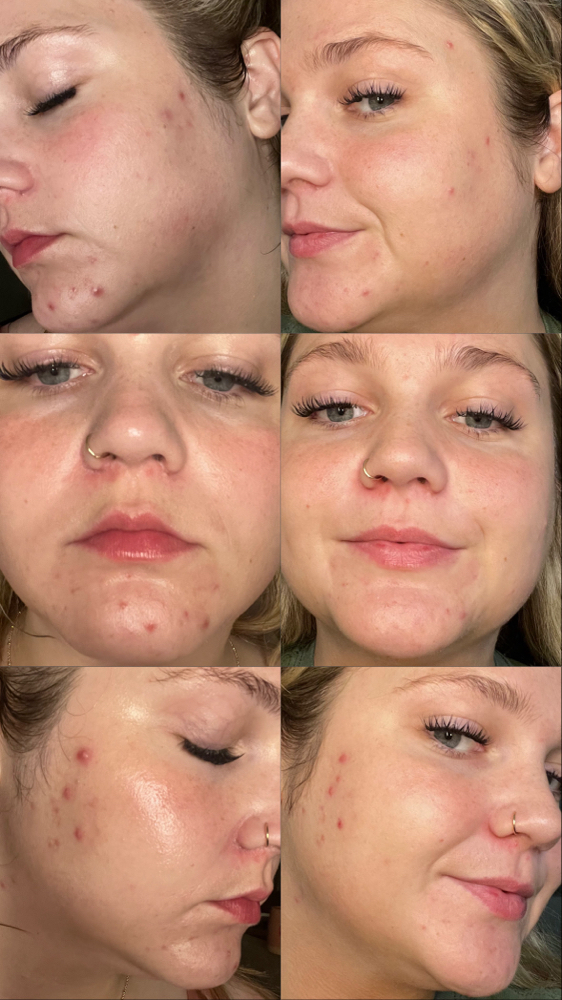 Corrective Acne Facial