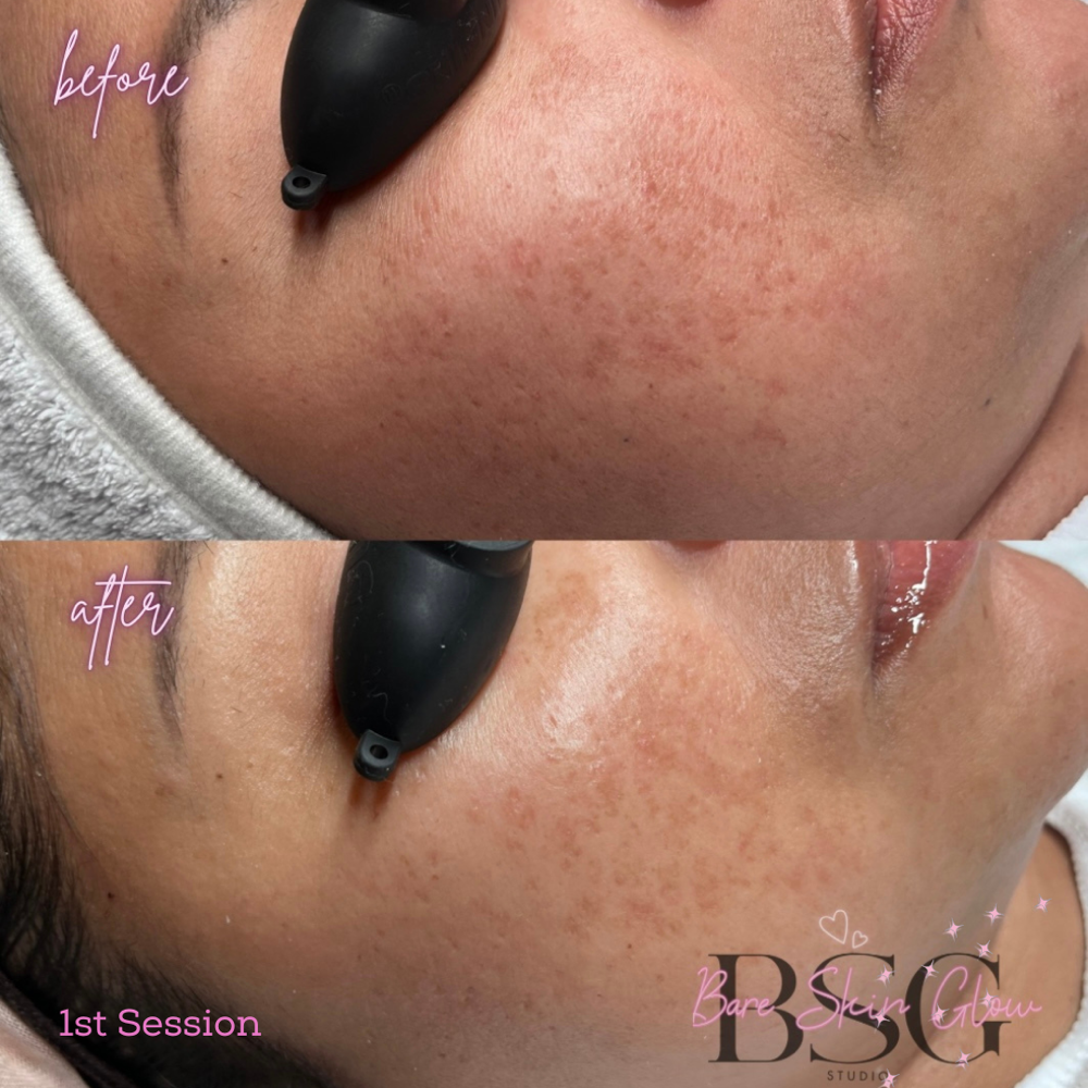 Vita Brite Peel Facial Express