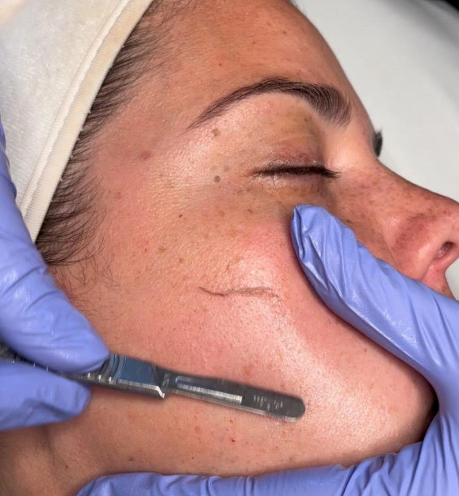 Dermaplane.