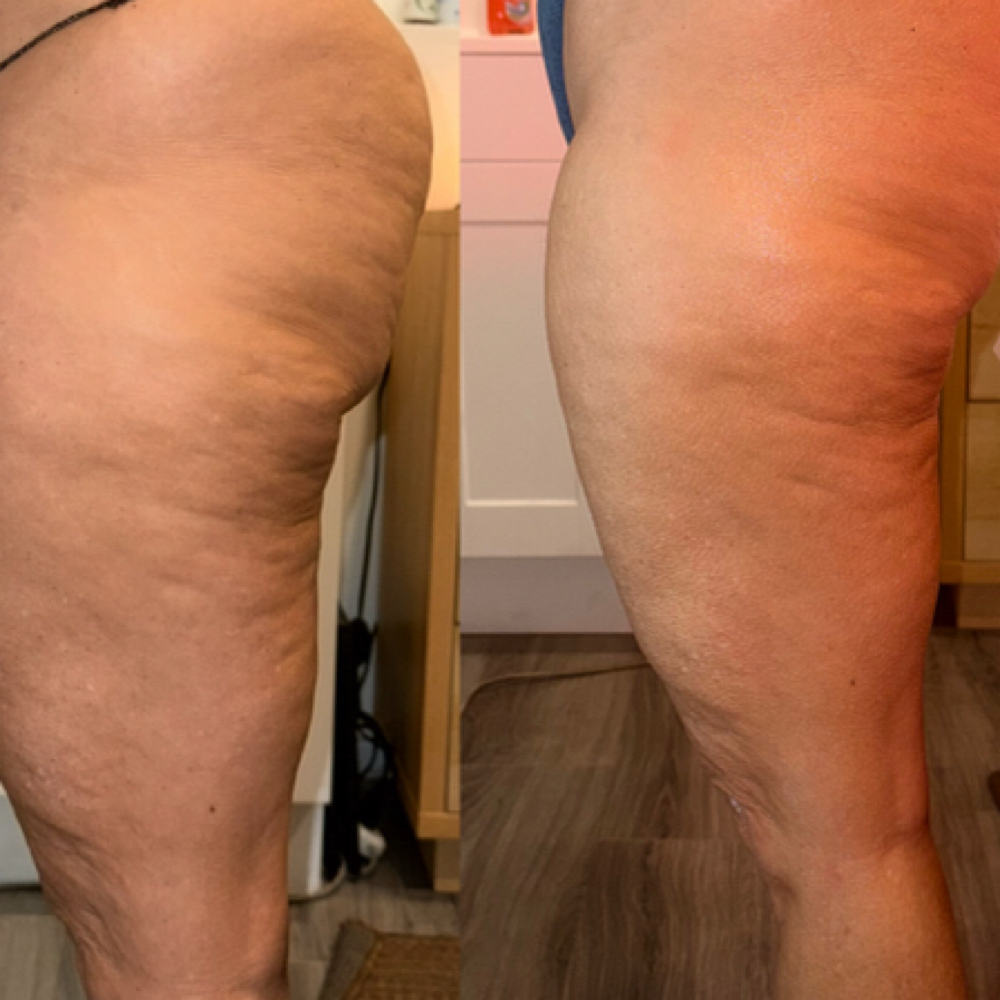 Cellulite Therapy at Sensational Wellness in California, CA