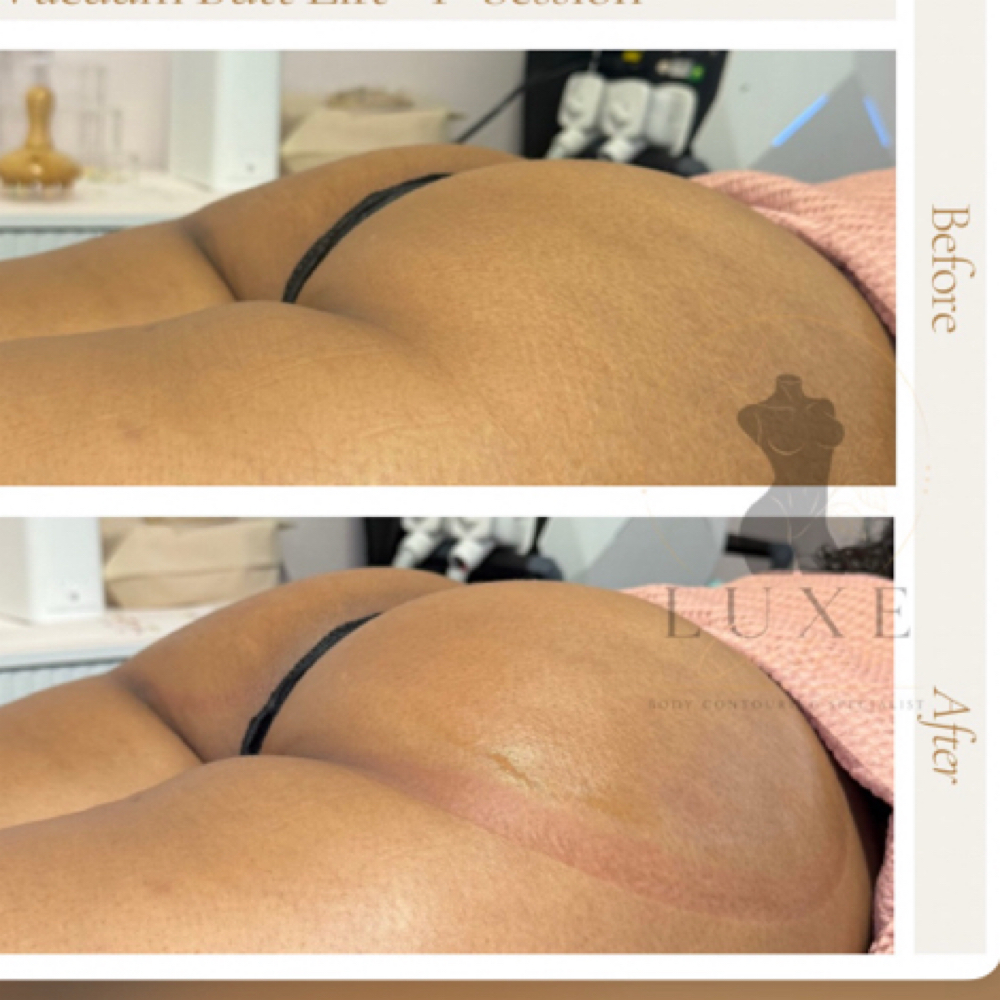 Luxe Butt Lift at Luxe Contour in Ontario, CA