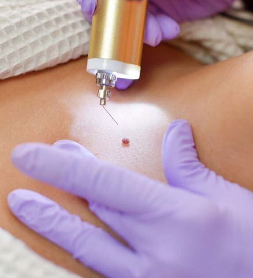 Skin Tag Removal