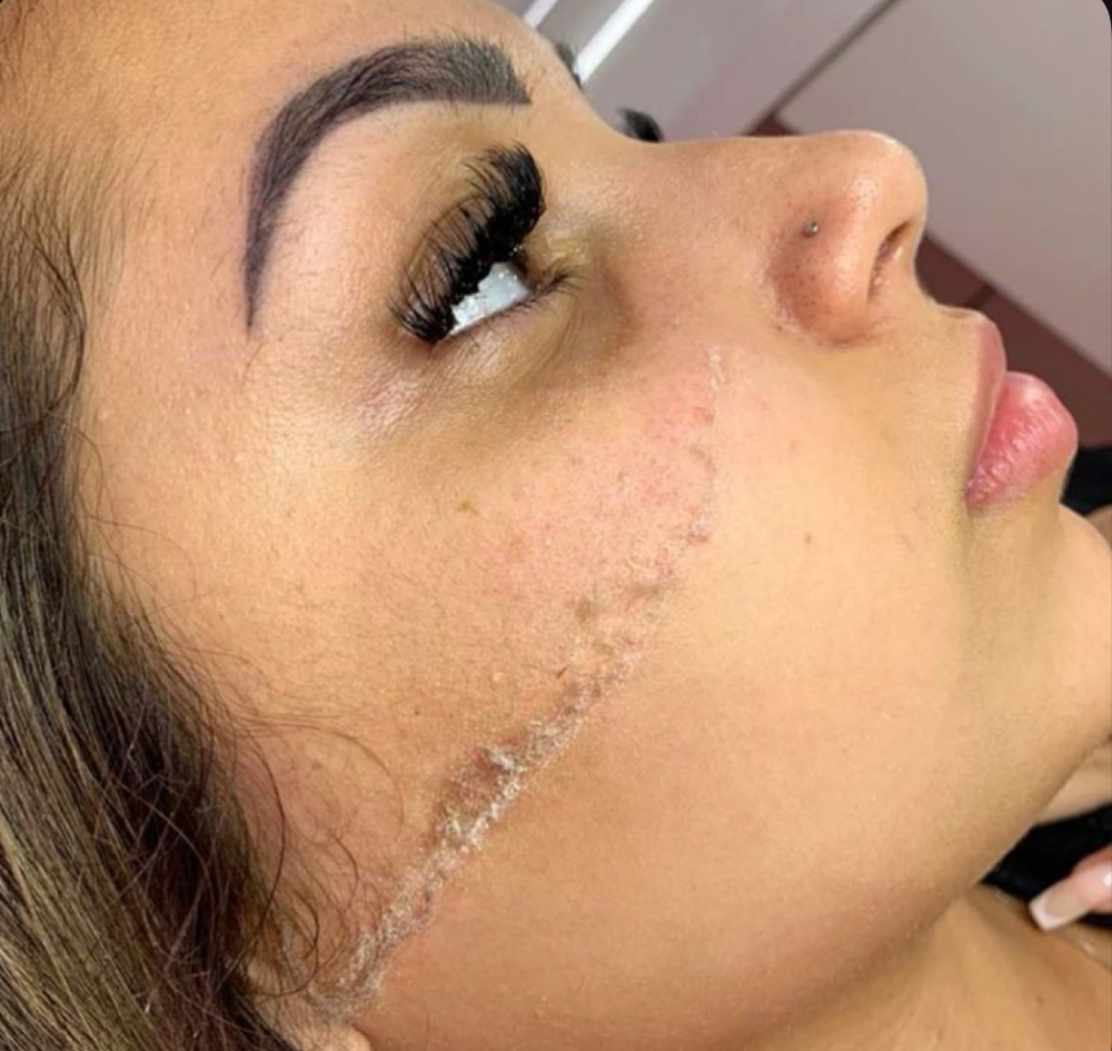 Dermaflash
