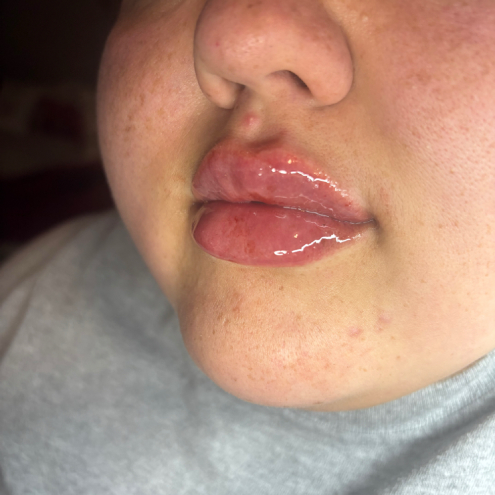 Lip 1.1 ML at Advanced Skincare & Laser By Jess in Naples, FL
