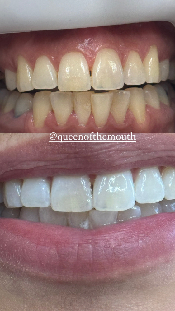 Consult W Same Day Whitening