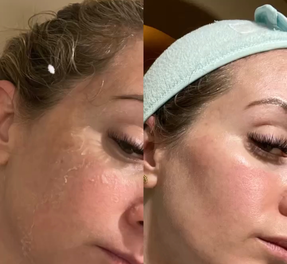 CHEMICAL PEEL