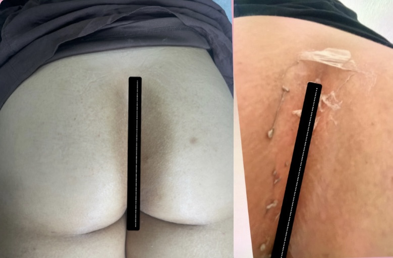 Inner/outer Glute Wall Skin Lighten at THE BEAUTY SLANGER in Hacienda Heights, CA