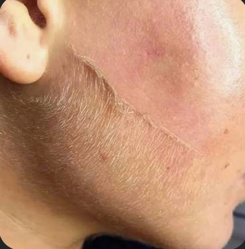 Add-On Dermaplane