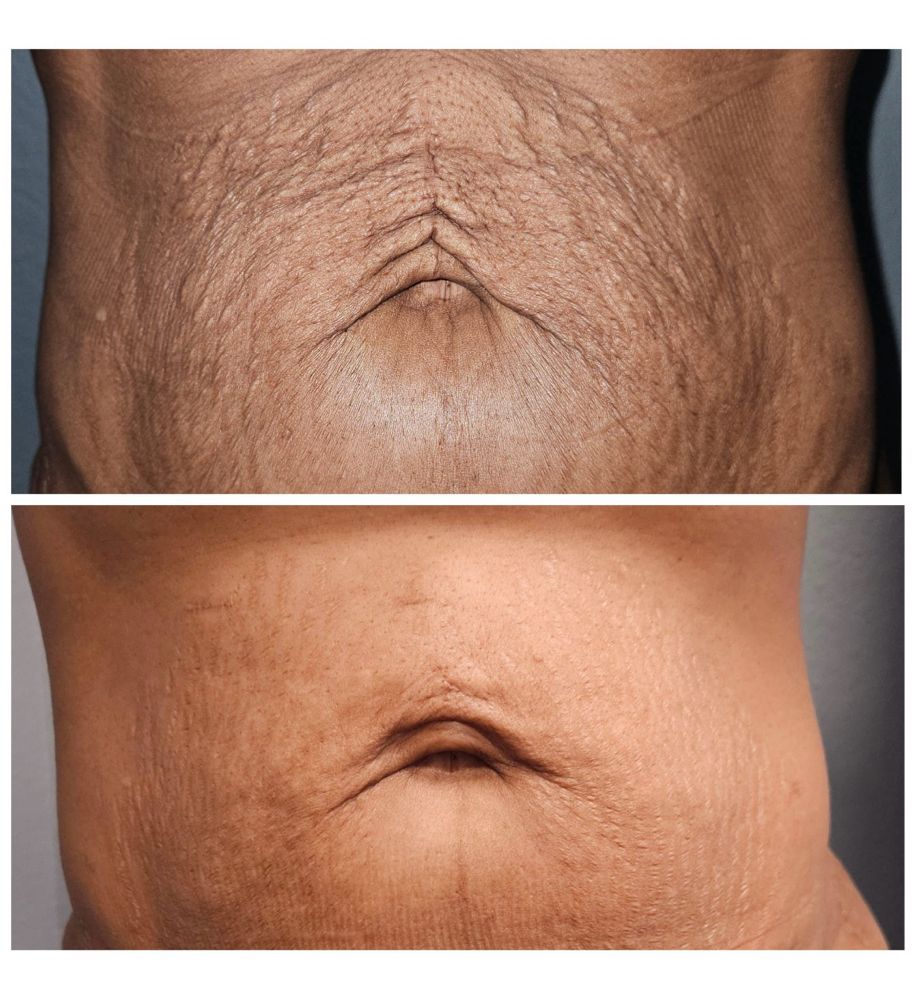 Tummy Tightening