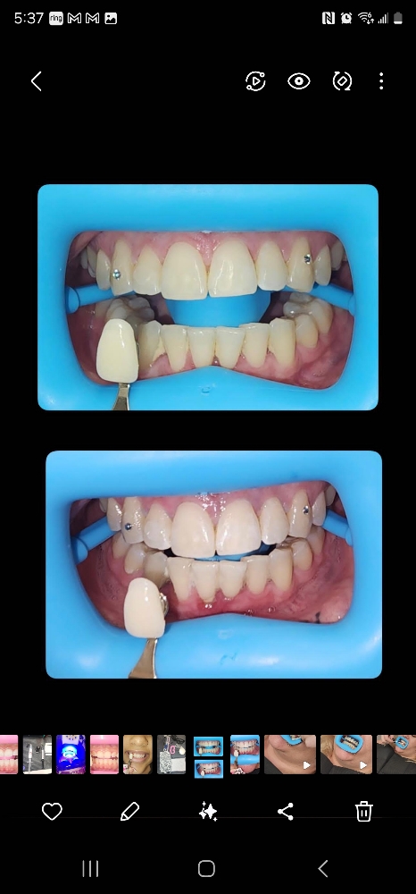 Teeth Whitening (60 Mins)