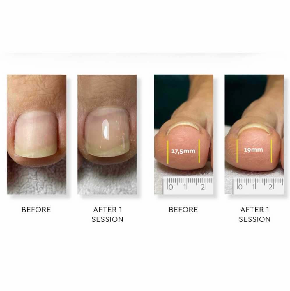 Ingrown Toenail Correction at Nails by Ellana in Lake Havasu City, AZ