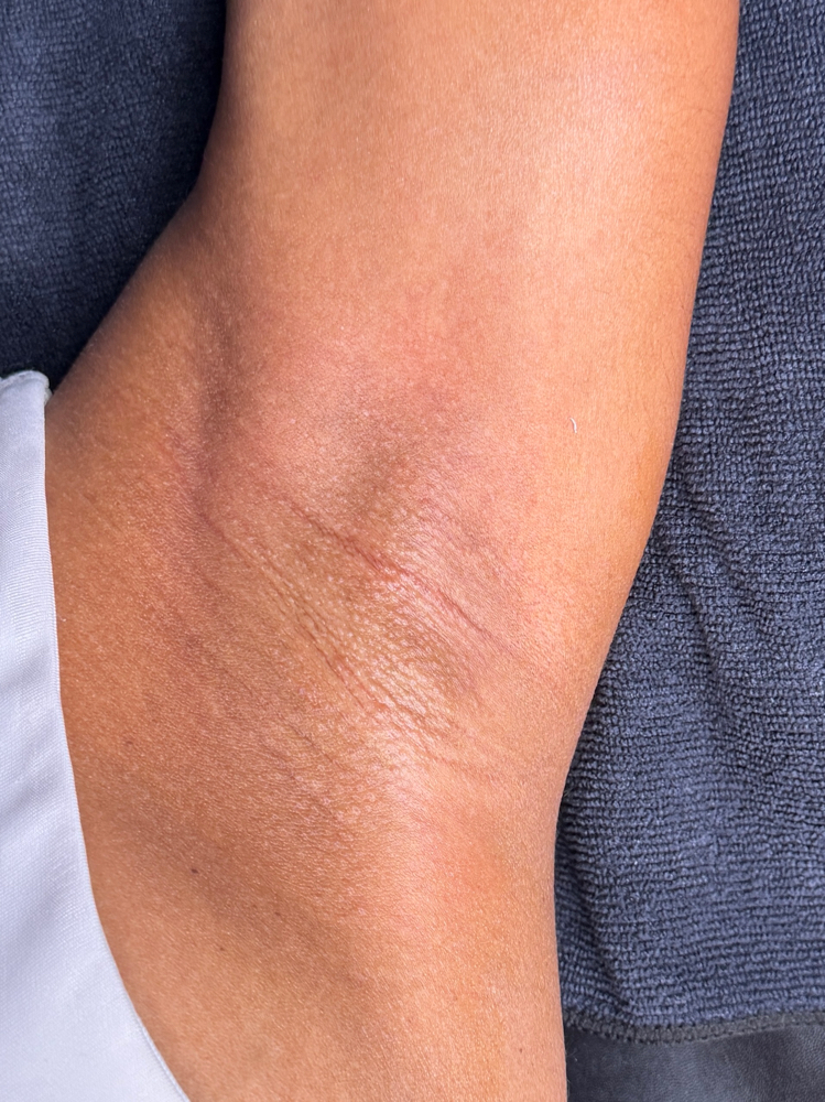 The Pits Perfect Facial