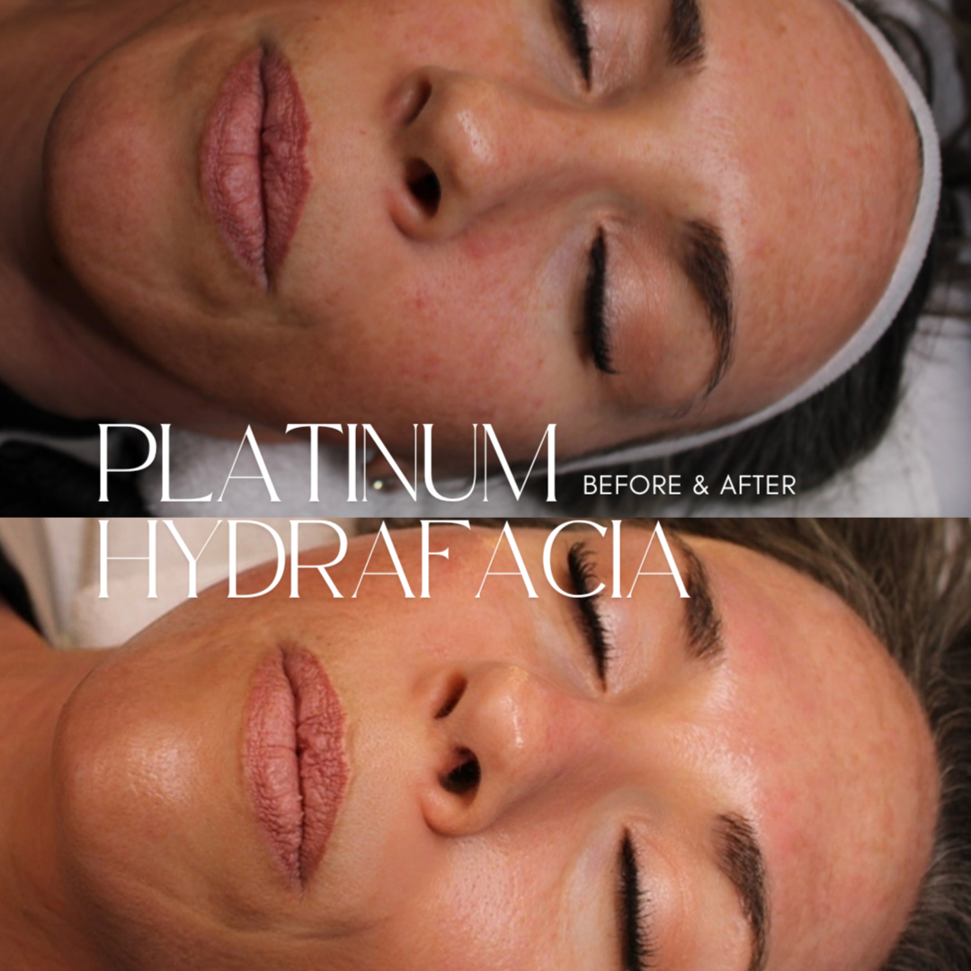 All About You Platinum HydraFacial at All About You Beautique in Eugene, OR