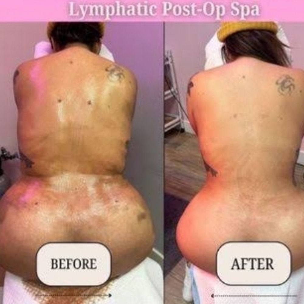 POST OP 5 Sessions at De lux beauty bar in New York, NY