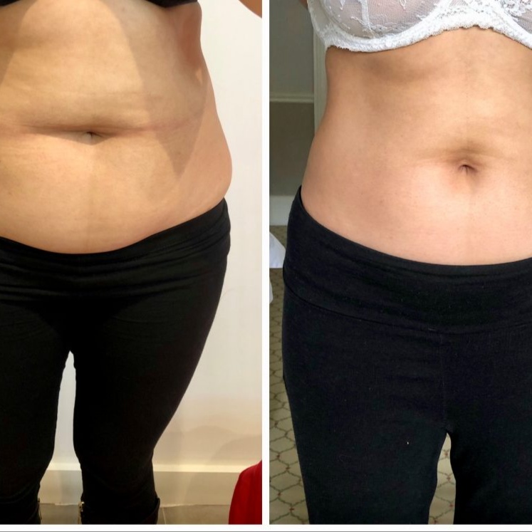 Skin Rejuvenation Tummy