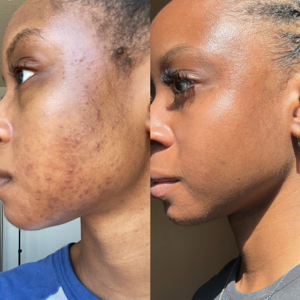 Pigment Correct Peel Package 1 at Oasiah Aesthetics in New York, NY