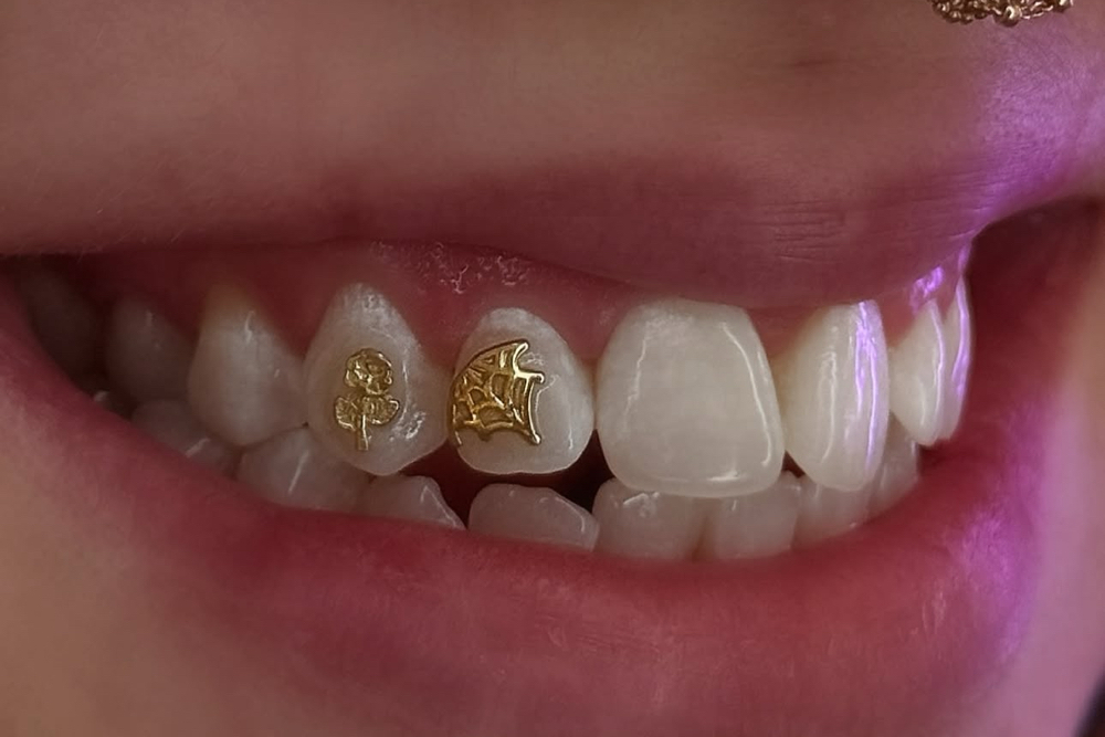 Consultation-Gold Tooth Gem