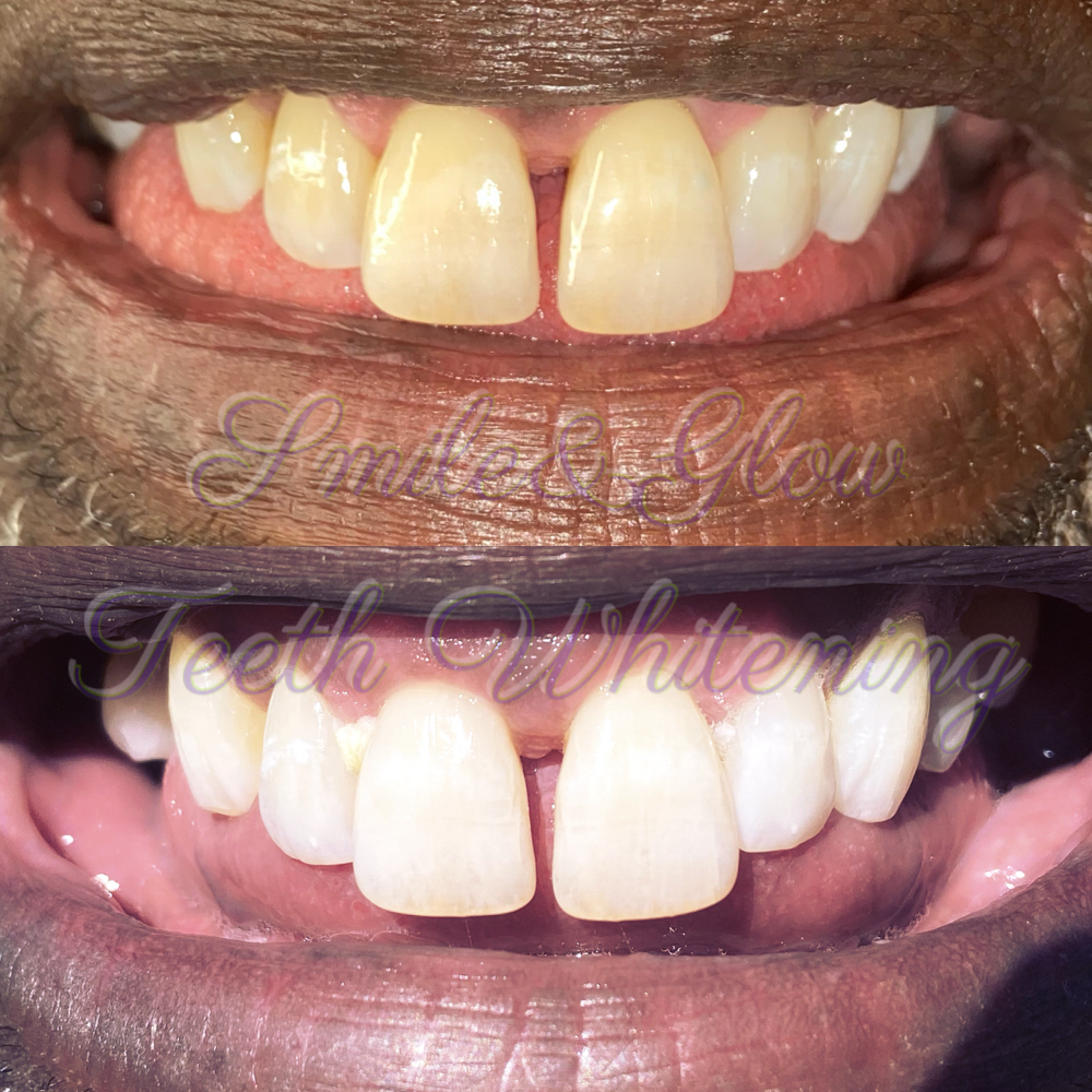 Half Whitening-Top/Bottom