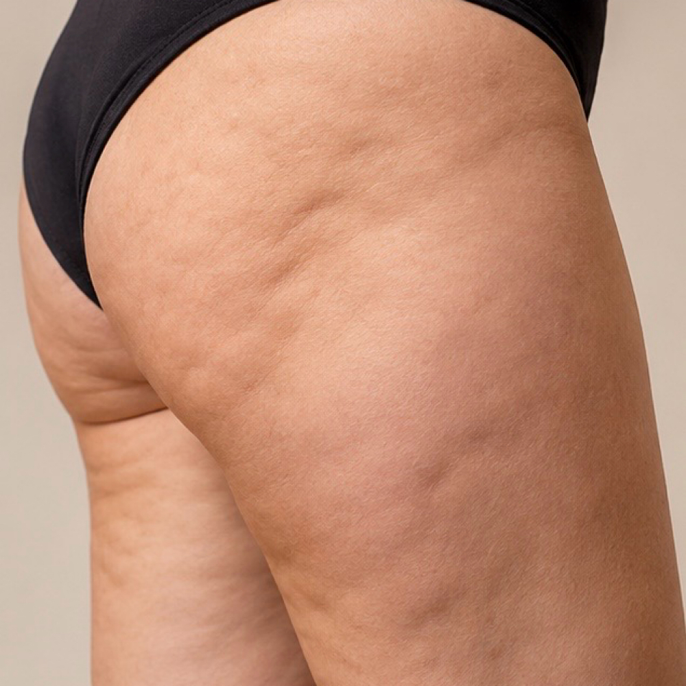 Cellulite Reduction & Skin Firming at Plasmalift Skin Clinic LLC in Bettendorf, IA