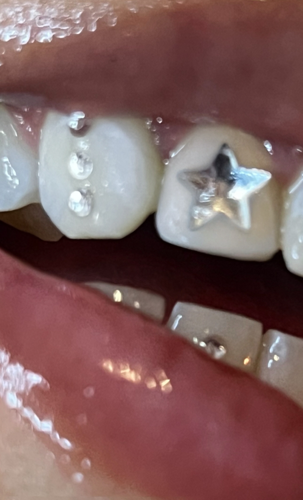 Tooth Gems