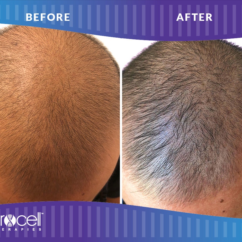 Hair Restoration at Ingrid Thompson Skincare in Beverly Hills, CA