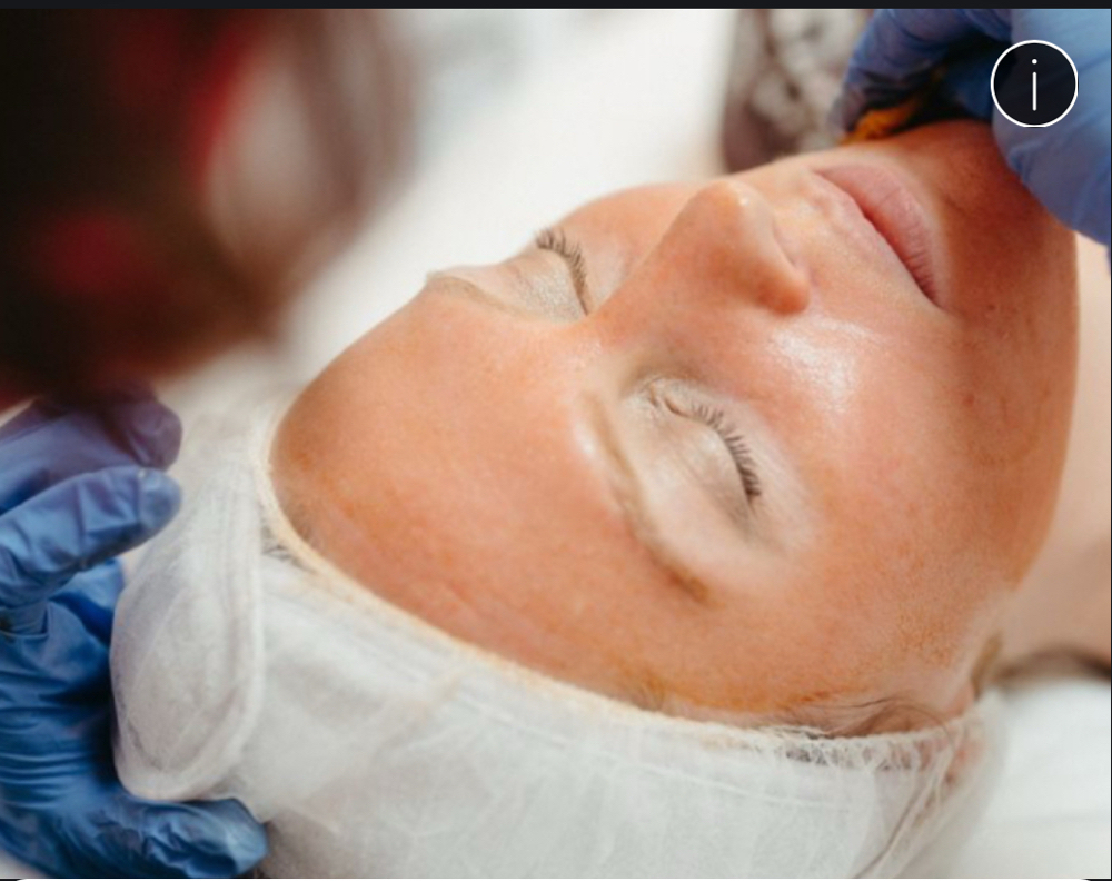 Refresh Peel Lactic Acid