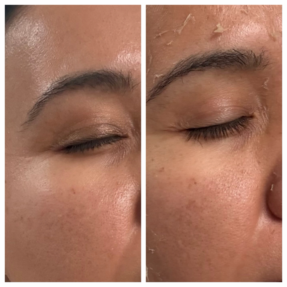 Mandelic peel at SD Peachy Aesthetics in National City, CA