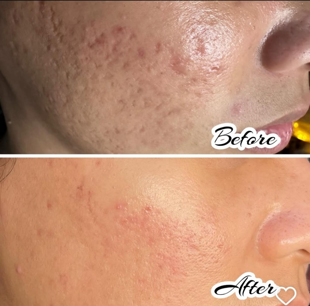 Microneedling + BioRePeel