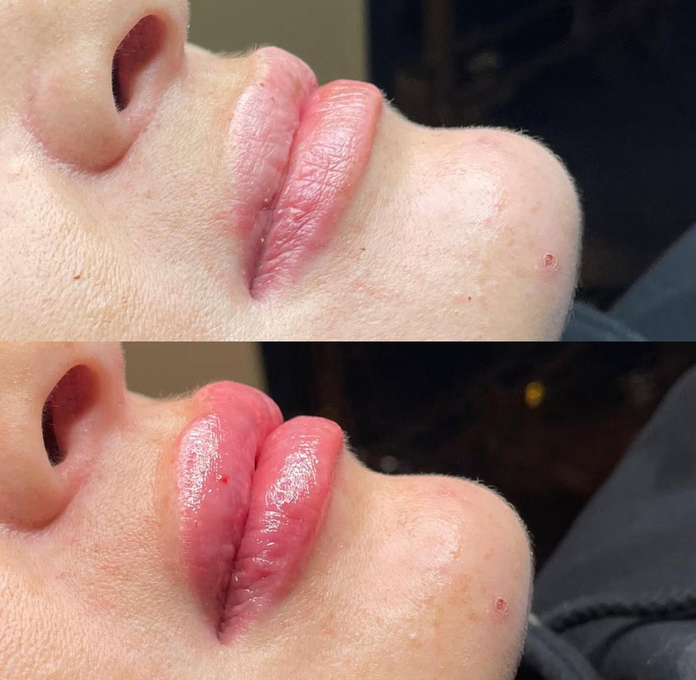 Lip Filler 2ML