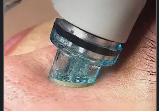 Microderm Pore Suction (vacumm)