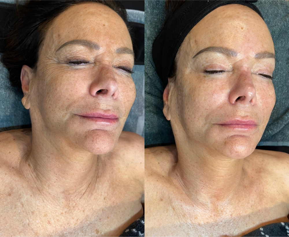 Korean Face & Neck Lift