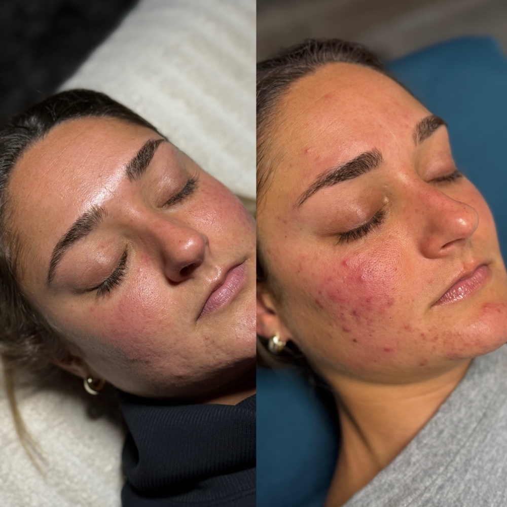Acne Consult + First Treatment at Taylor’d To You - AWE Skin Studio in Lebanon, TN