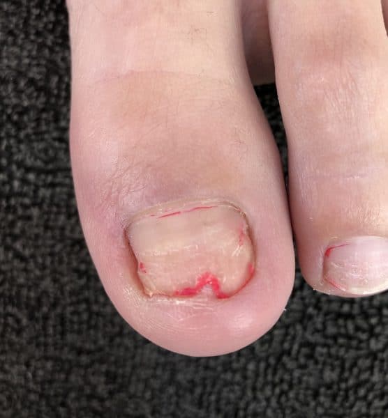 NAIL FIX (1 FINGER)
