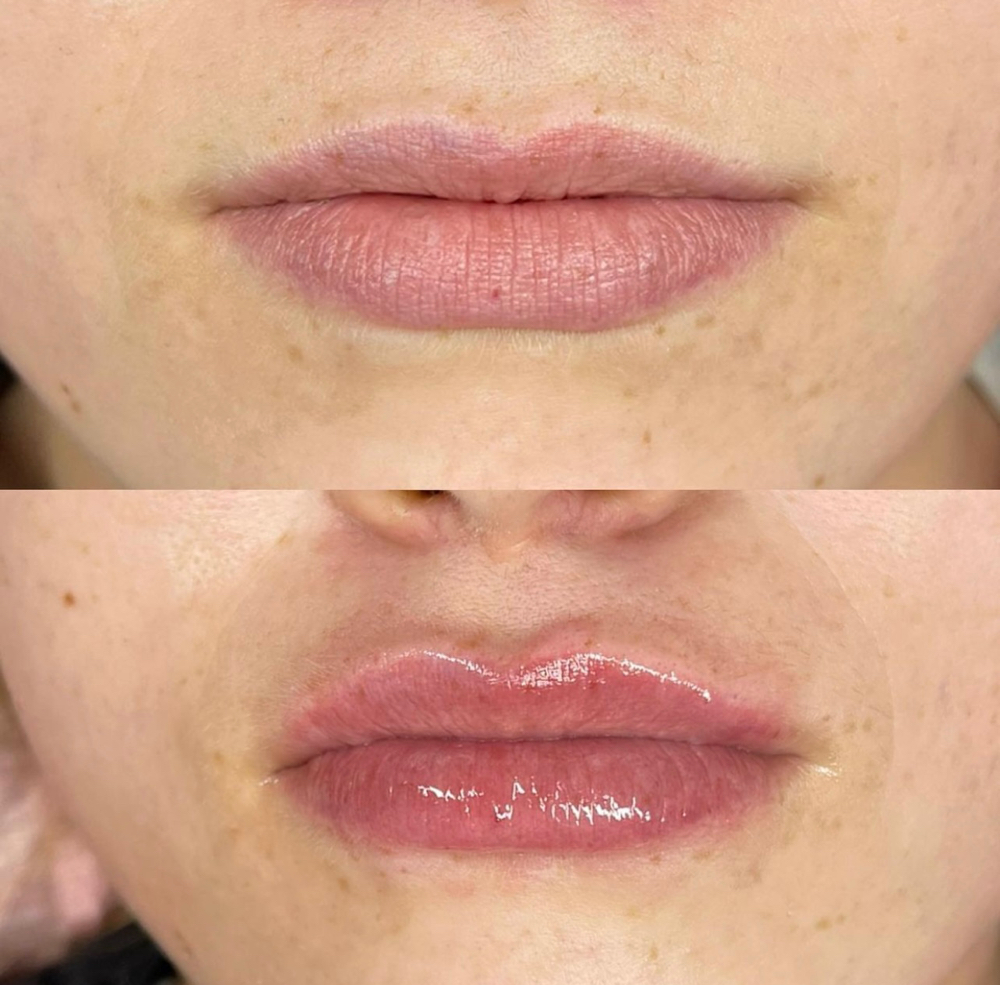 Lip filler 1mL at Beautybarbyjp in Murfreesboro, TN