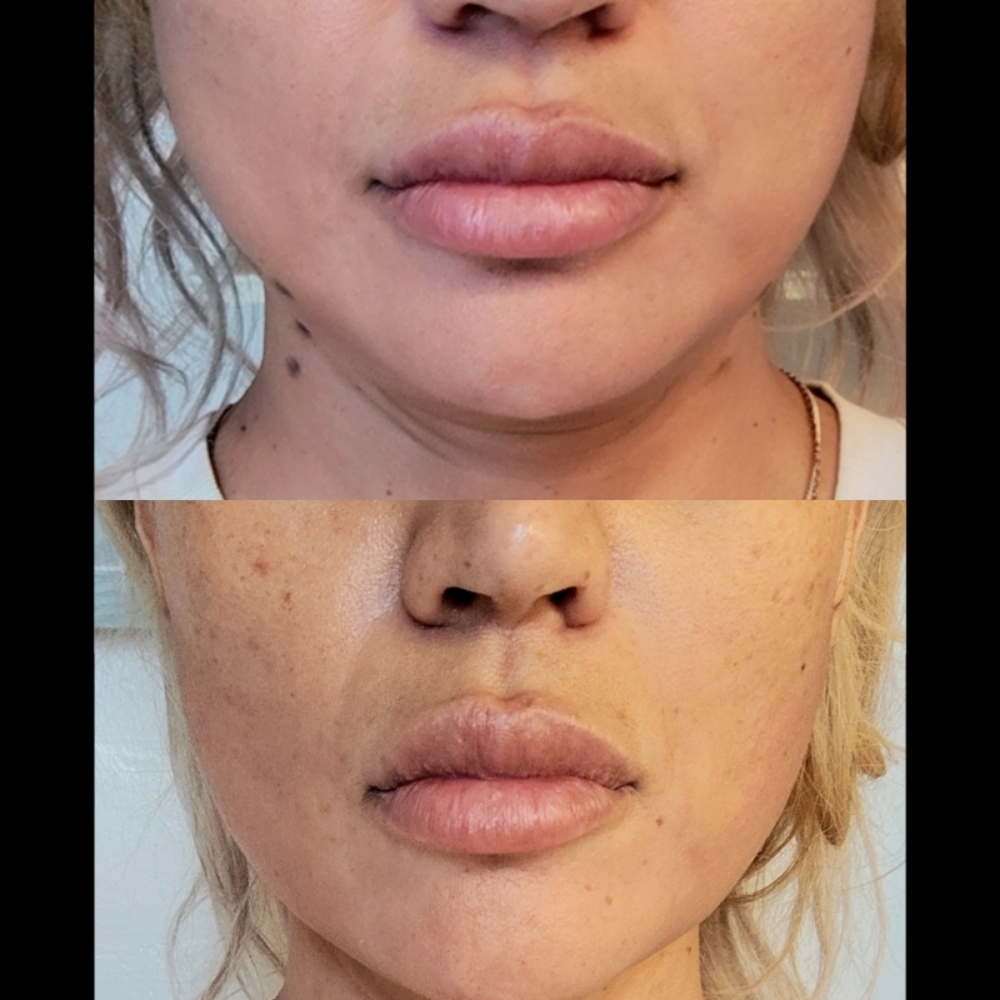 V-LINE SPECIAL MASSETEER BOTOX+LIPO at Boujee Asthetics ✨ in Tucson, AZ