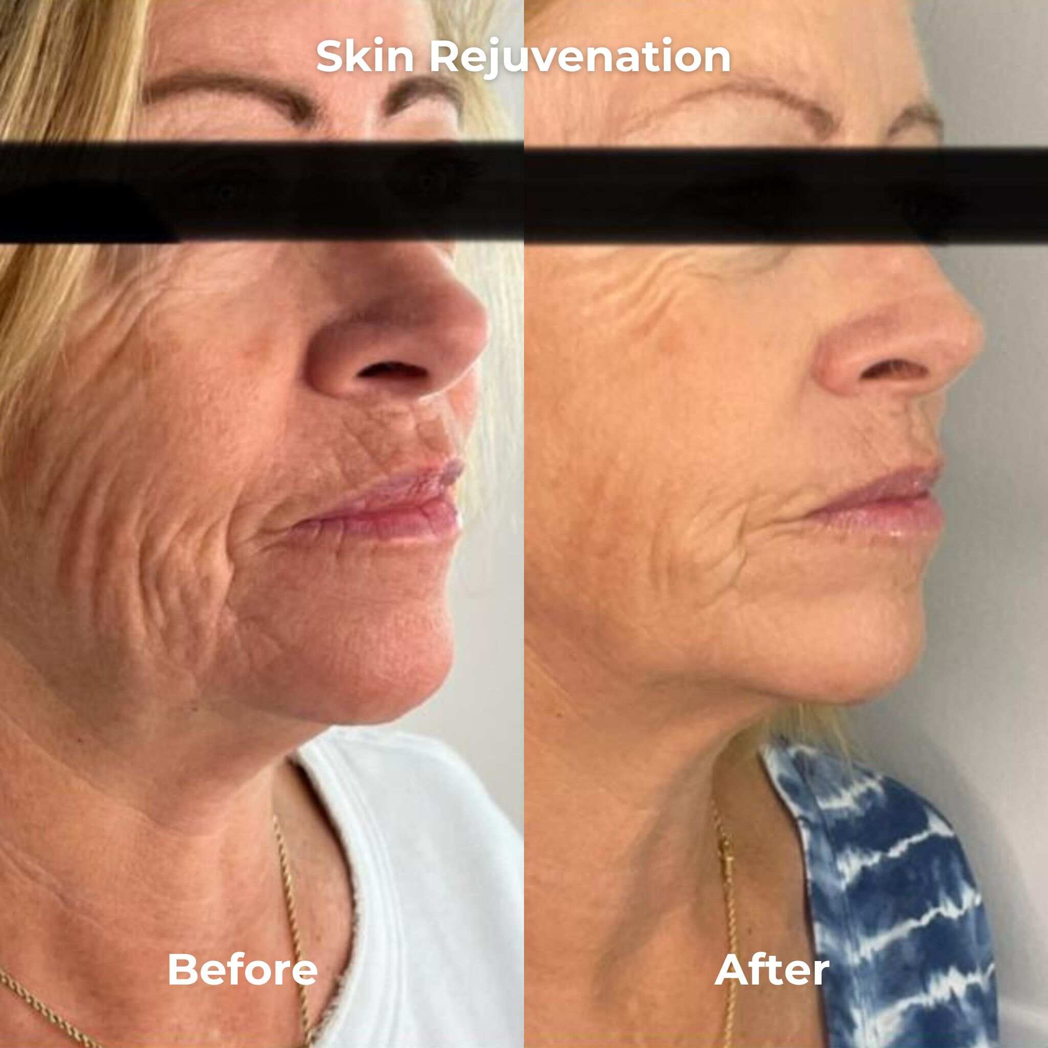 Virtue RF Microneedling