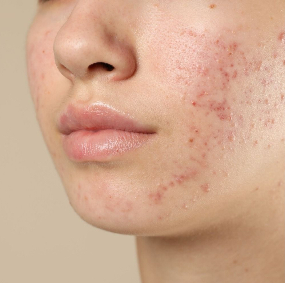 Acne Facial at Bare By Kady in Lufkin, TX