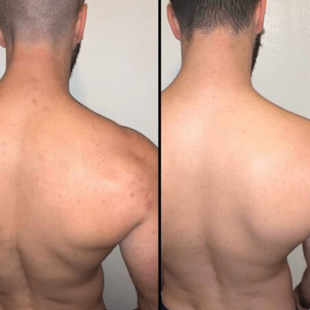 Salycitic Back Peel at Tonya Mann Stylist And Esthetician in Owensboro, KY