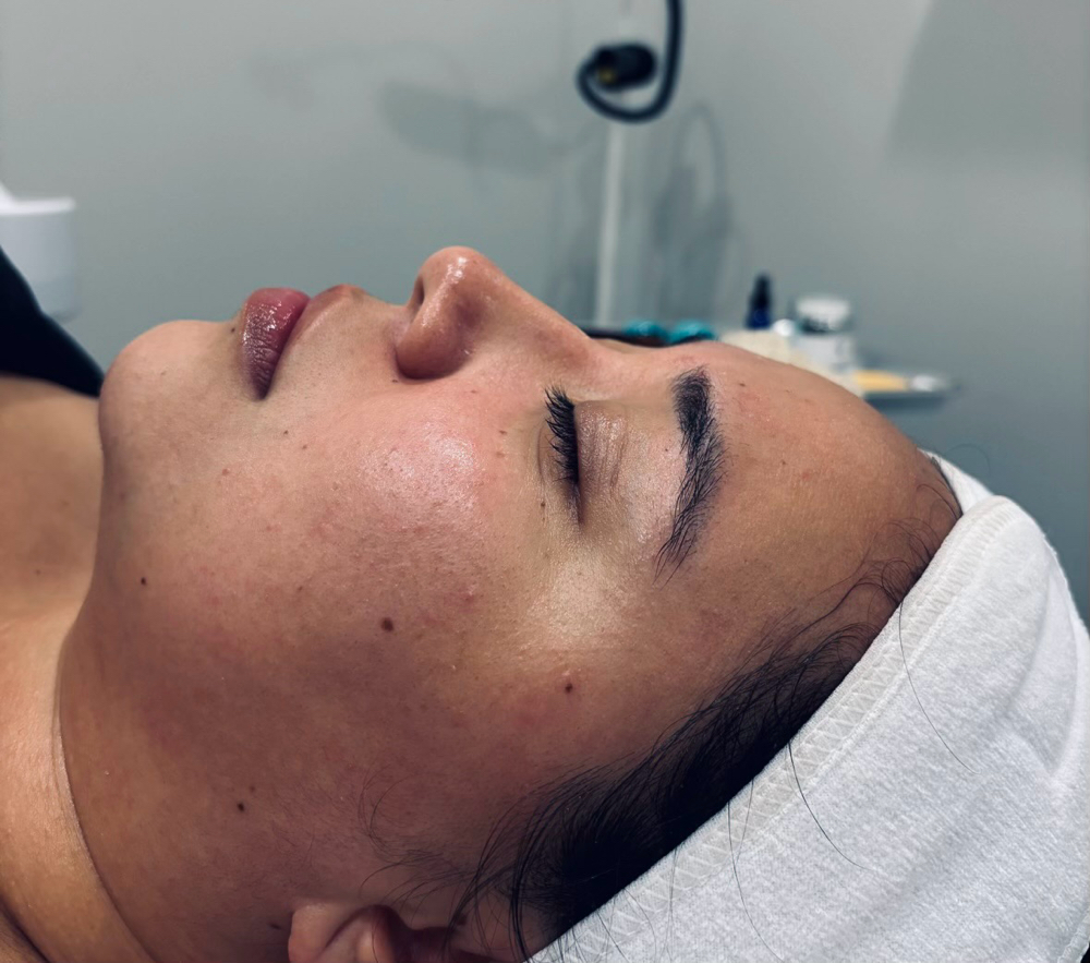 Acne Boot Camp Facial