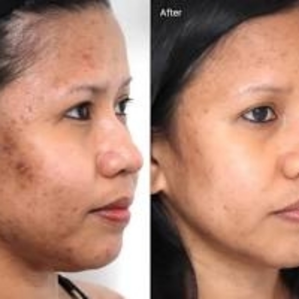 Chemical Peel Facial at Lilies Boutique Day Spa in Lanesboro, MN