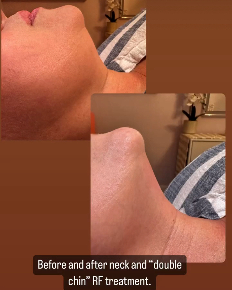 Rf Treatment For The Neck