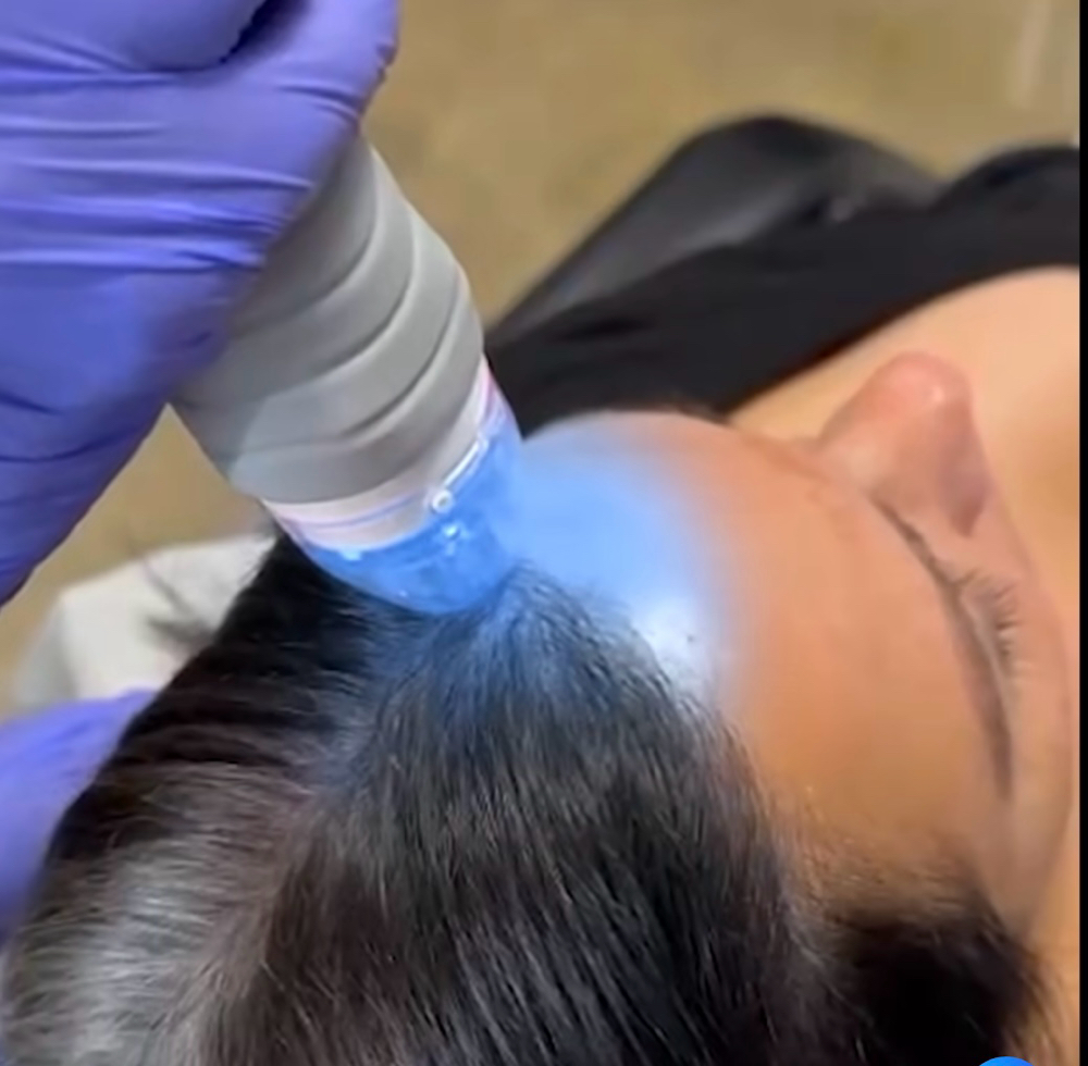 Hair Fractional RF at SkinGlow in Naples, FL