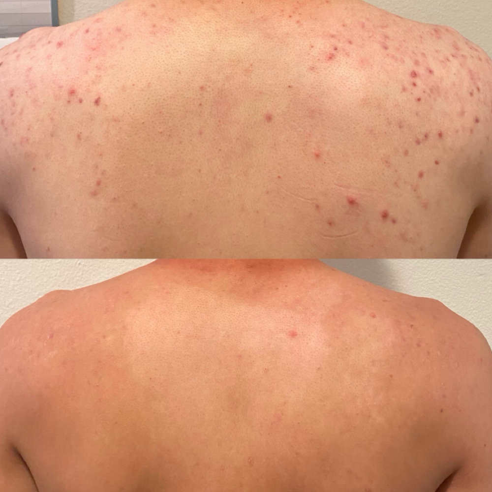 Back Microneedling at Esthetic By Val in Clinton Township, MI