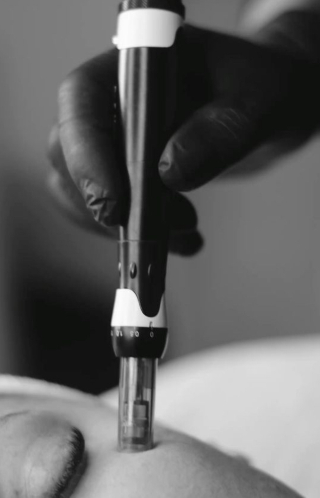 Microneedling
