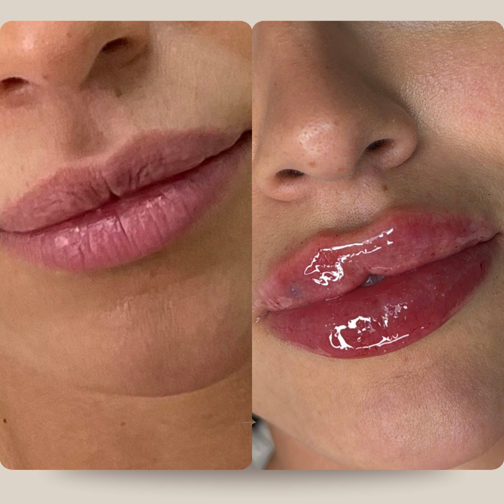 Lip Filler -Half Syringe