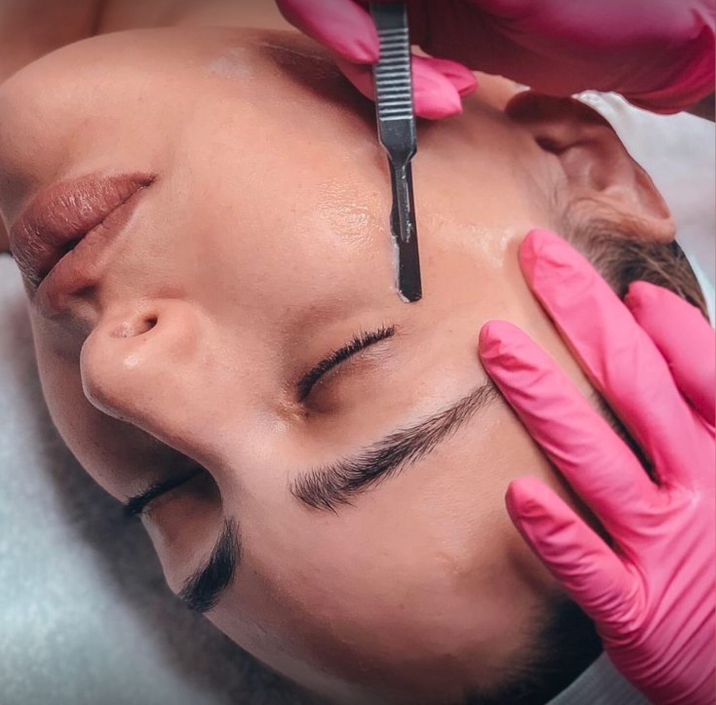 Dermaplaning