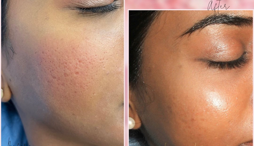 Acne Scar Rejuvination