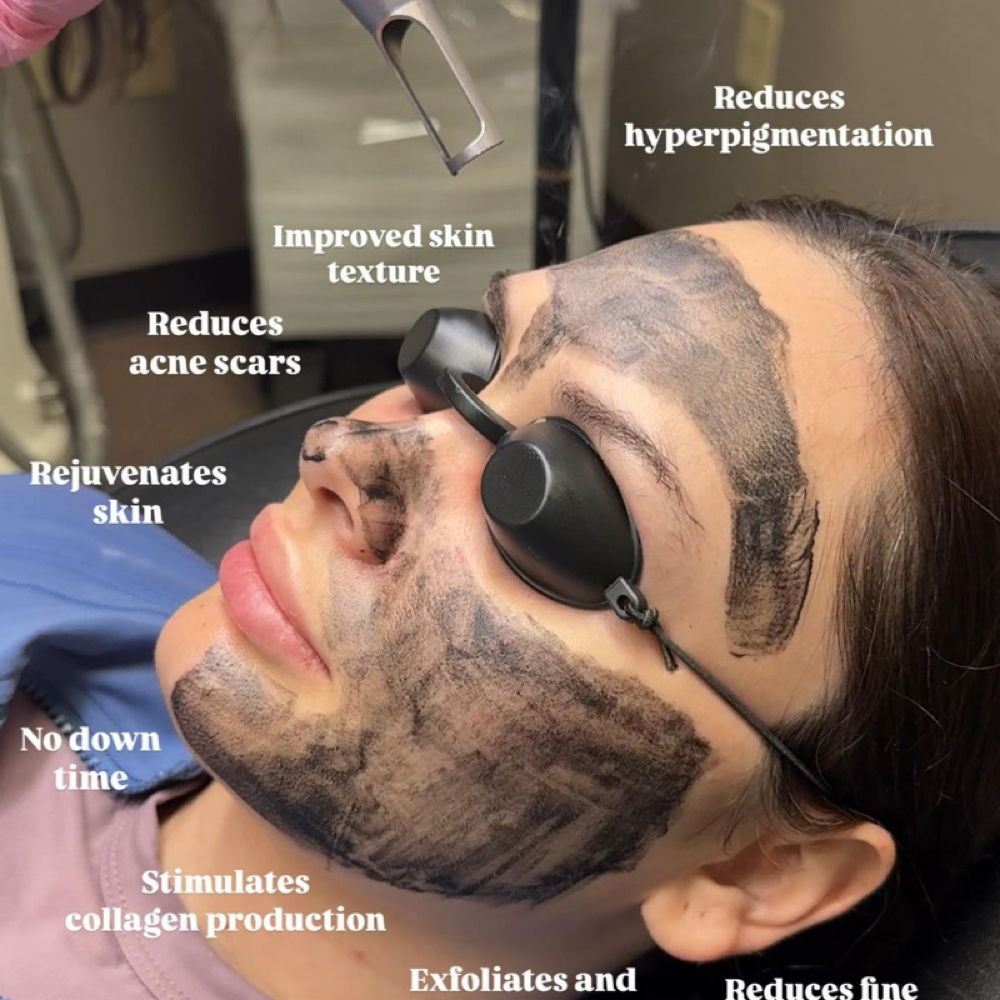 Carbon peel Facial Treatment at Velvet Pro Beauty in Brentwood, CA