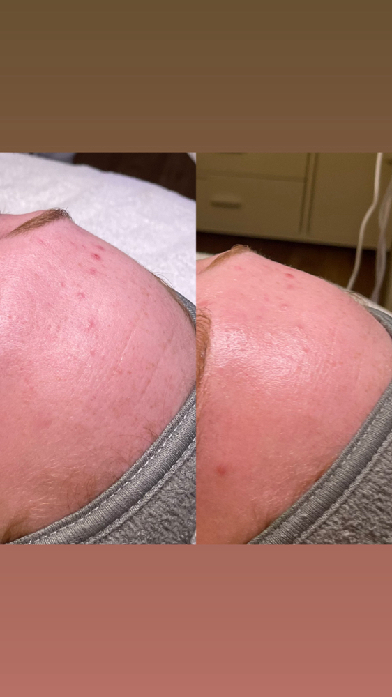 Resurfacing Chemical Peel