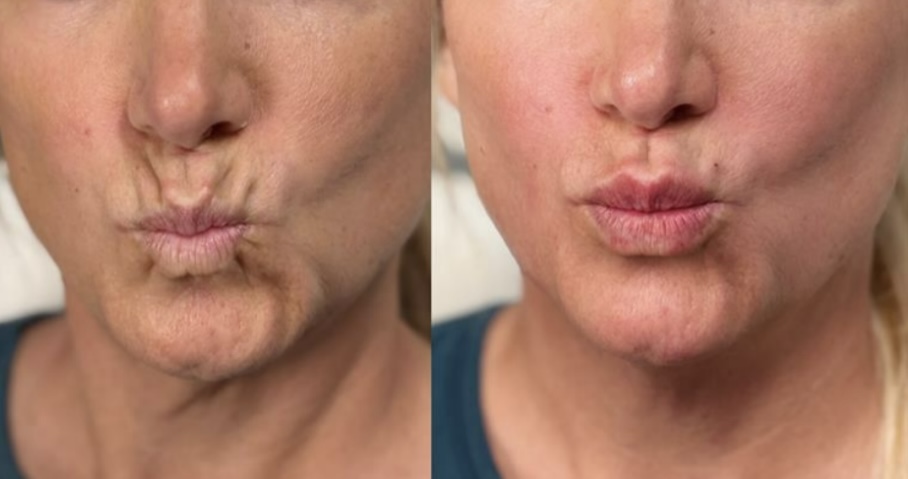 Perioral Filler “Smoker Lines”
